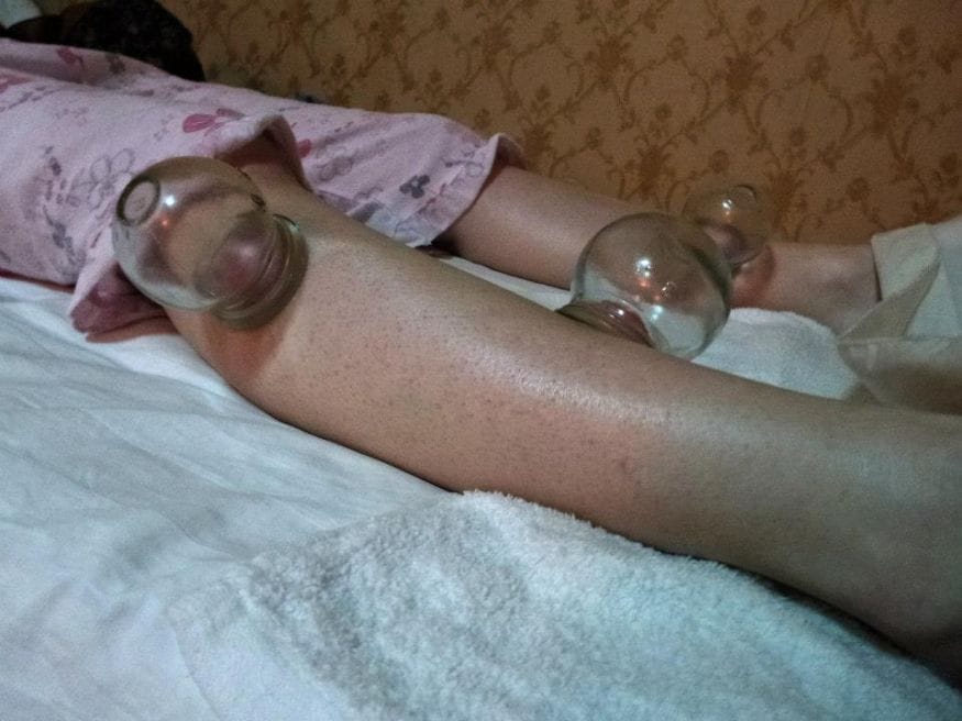 Cupping therapy 2 unusual beijing